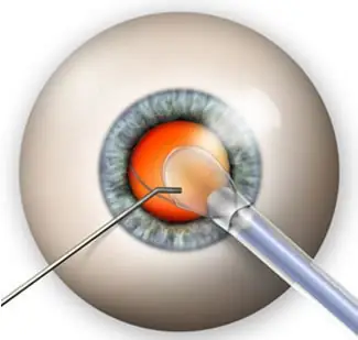 Operacija katarakte - UGRADNJA MULTIFOKALNIH SOČIVA - AKCIJA