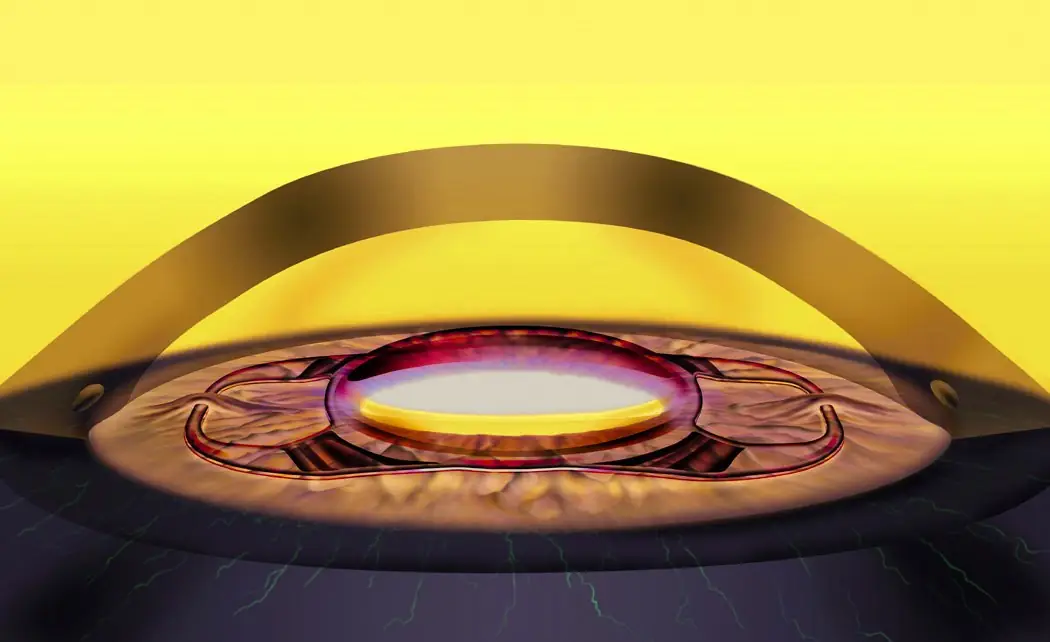 Operacija katarakte - Ugradnja multifokalnih sočiva - prolećna akcija