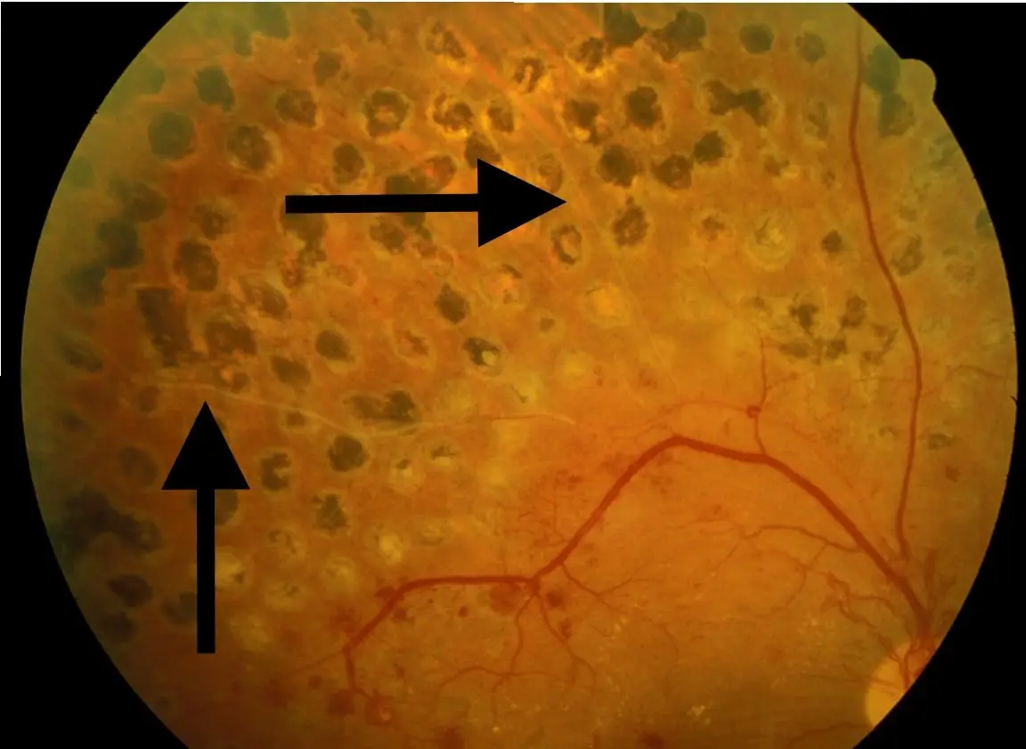 Lasersko skidanje dioptrije - Četiri godine sa Vama i uz Vas!