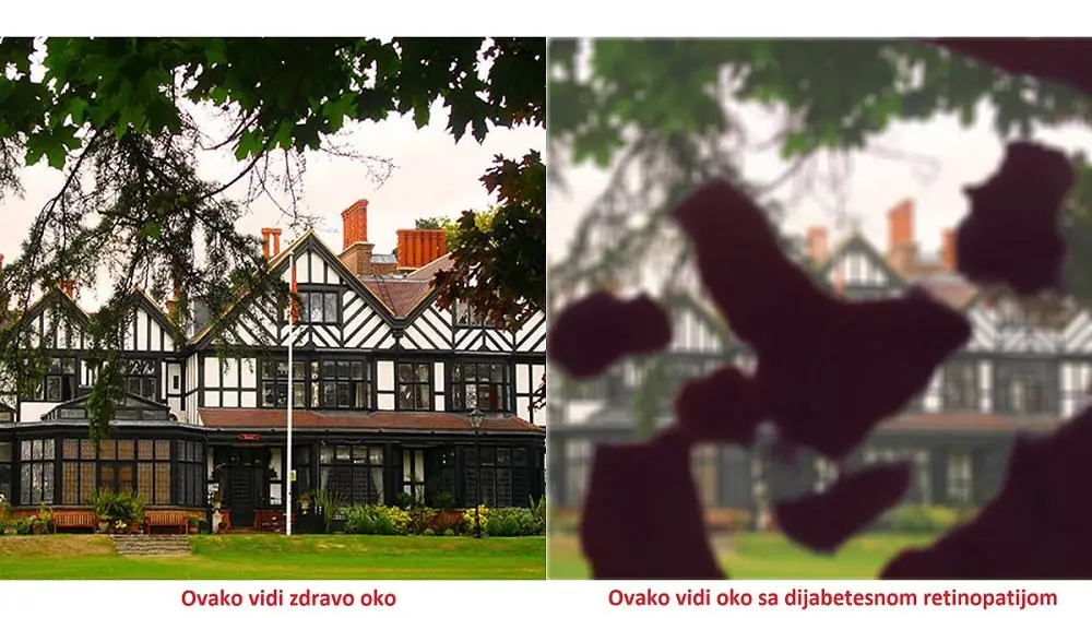 Dijabetesna retinopatija - Tradicionalna akcija povodom Svetskog dana borbe protiv dijabetesa