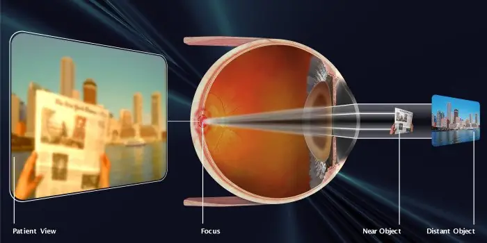 Operacija katarakte - Iskustvo operisanog pacijenta iz Bijeljine