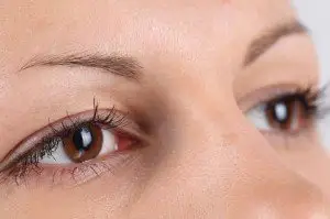 Alergijski konjuktivitis