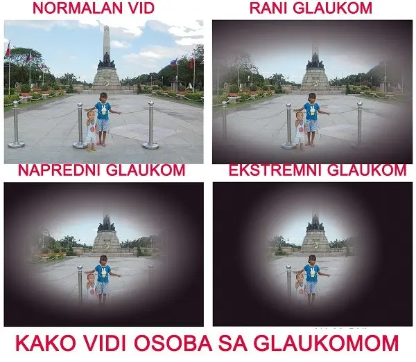 Faze glaukoma – ilustracija sužavanja vidnog polja