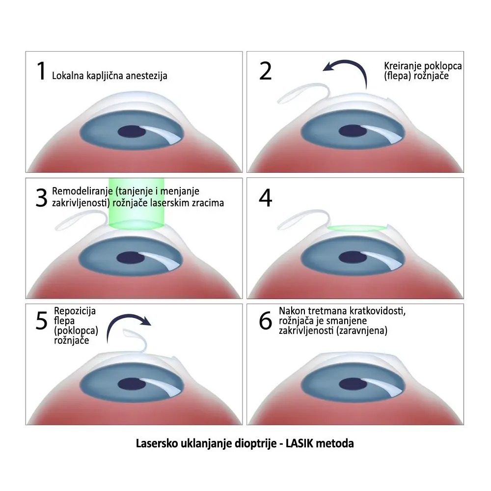 LASIK korak po korak