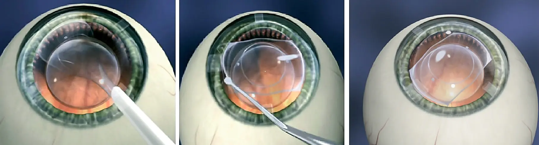 Simulacija ugradnje faknih sočiva