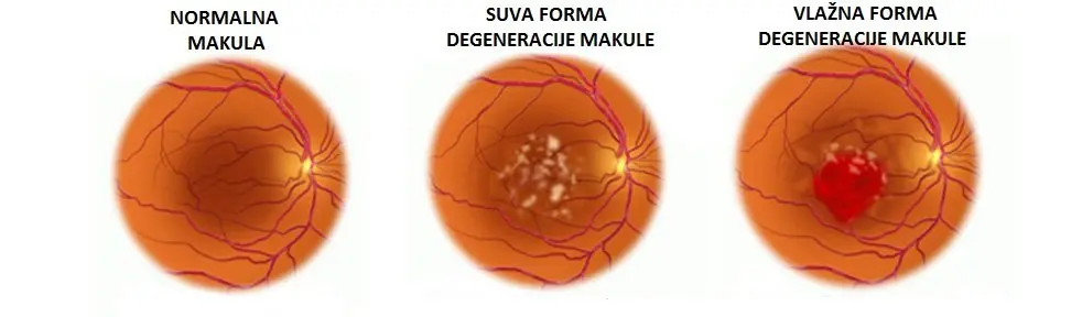 Senilna degeneracija žute mrlje